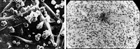 FIG. 33a&b- Depleted Uranium Hollow Spherical Particulates and Hot Particle Alpha Tracks in Lung Tissue